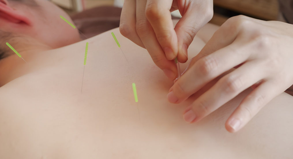 鍼灸